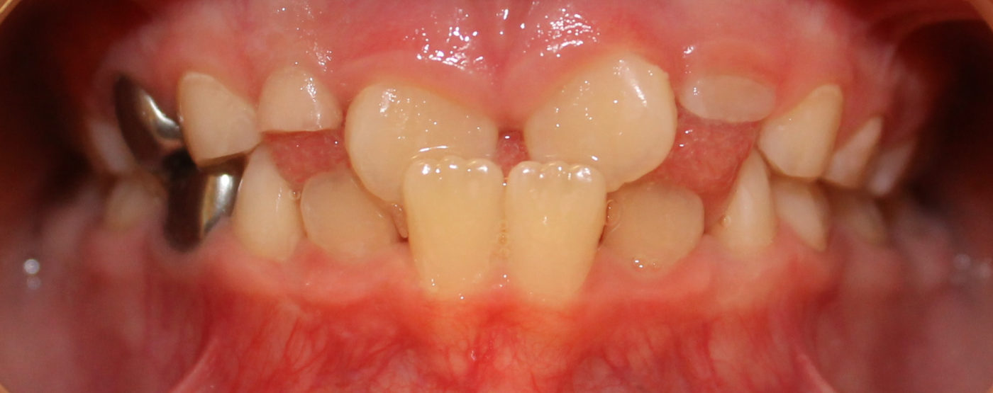 PT 9 Crowding front teeth COLOR